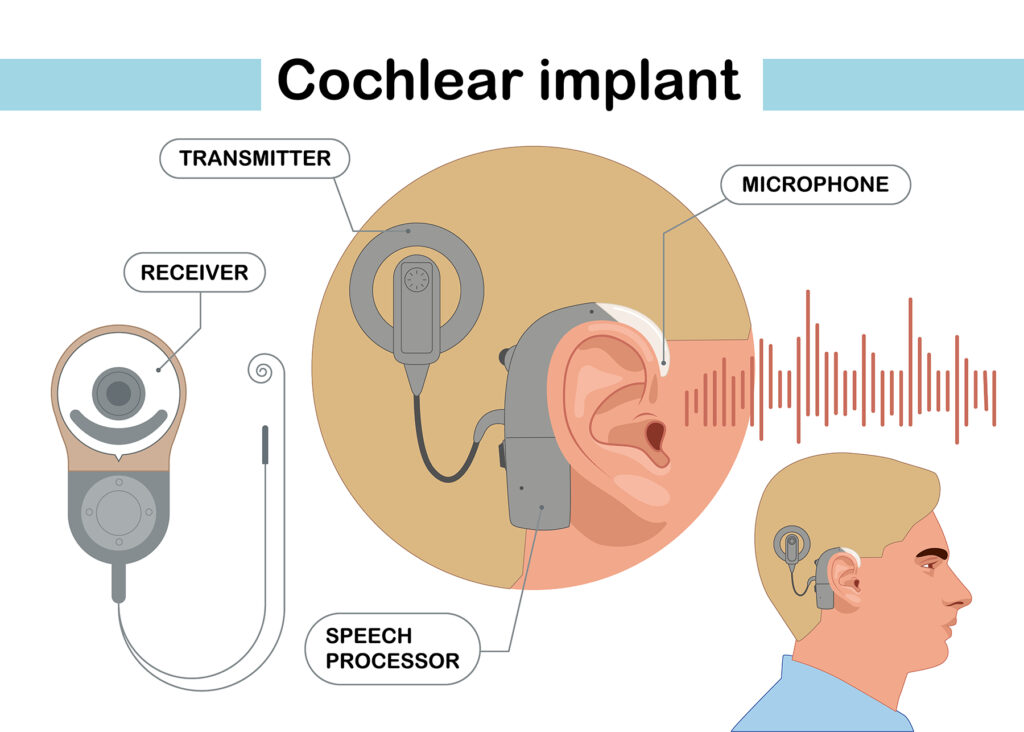 infographic of an ear implant